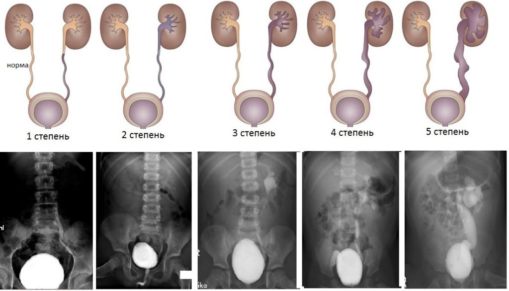 Пузырно лоханочный рефлюкс у детей