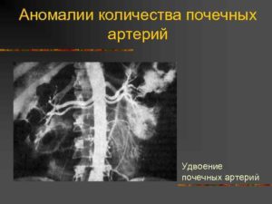 Удвоение артерий почек