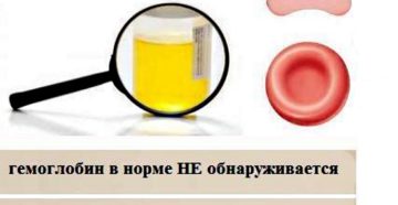 Эритроциты 13 в моче у ребенка