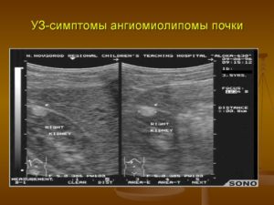 Ангиомиолипома паренхимы левой почки