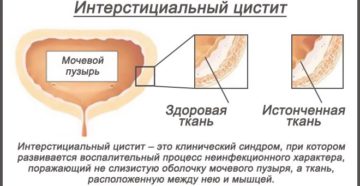 Как восстановить слизистую мочевого пузыря после цистита