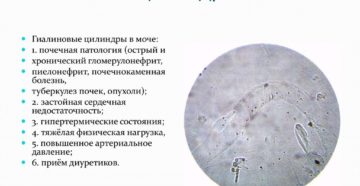 Что значит цилиндры в моче