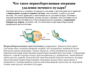 Удалили мочевой пузырь как жить дальше