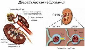 Почки при сахарном диабете 1 типа