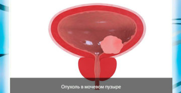 Рак мочевого пузыря прогнозы на жизнь