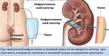 Как снимают нефростому из почки