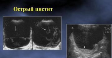 Узи мочевого пузыря цистит