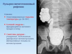 Симптомы рефлюкса почек