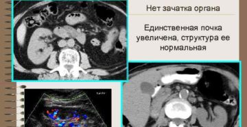 Единственная почка увеличена