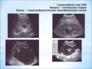 Гидронефротическая трансформация правой почки плода