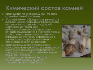 Какие камни образуются в почках при повышенной мочевой кислоте