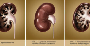 Расширение члс правой почки что это