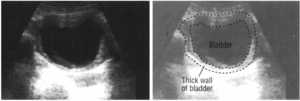Утолщенные стенки мочевого пузыря причины