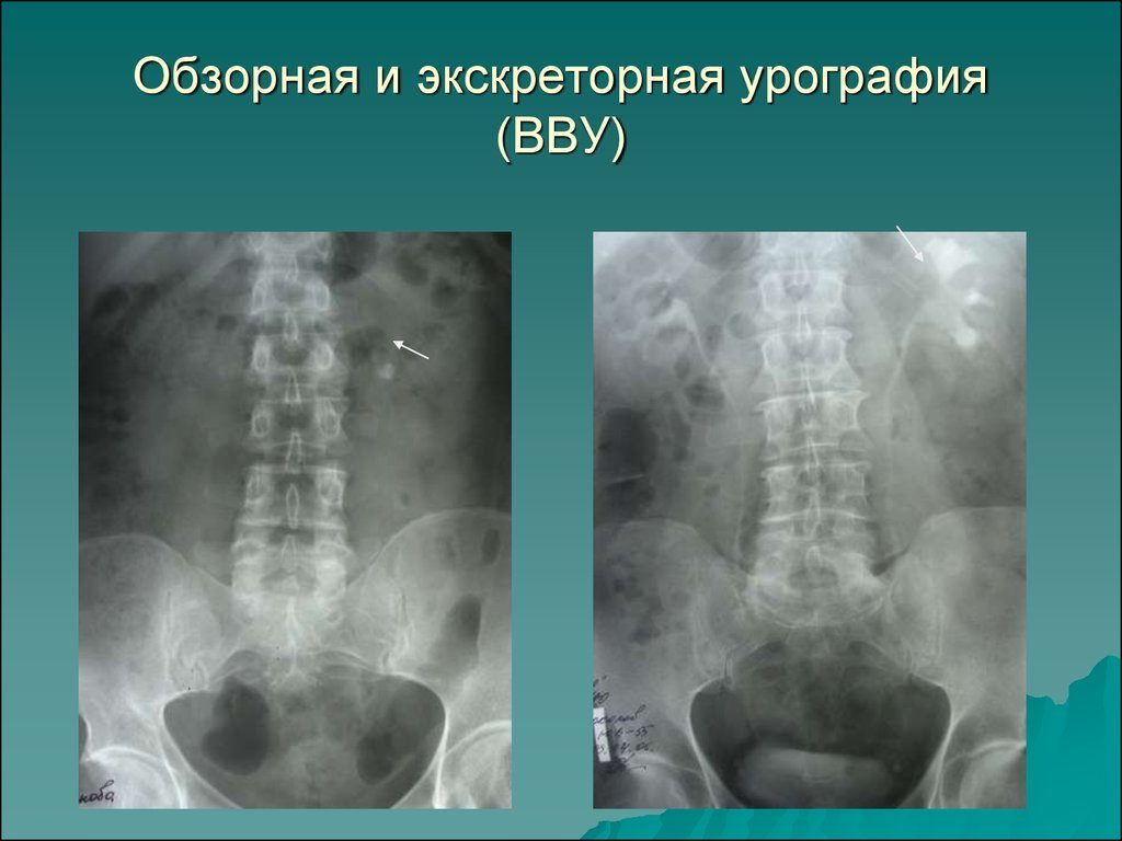 Обзорная урограмма почек как делают