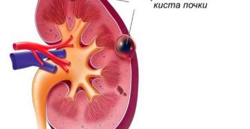 Что такое кальцинированная киста почки