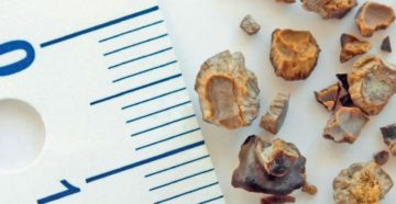 После дробления камней в почках кровь в моче