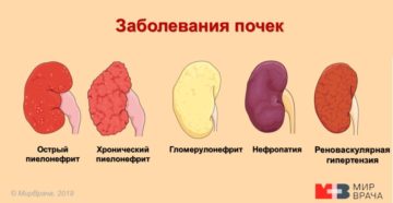 Национальные рекомендации по нефрологии 2015 хронический пиелонефрит