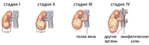 Рак почки четвертая стадия