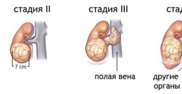 Рак почки четвертая стадия
