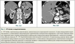 Кт описание почек