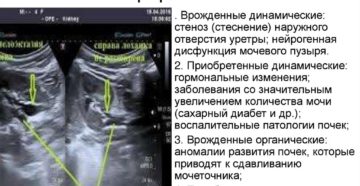 Что такое двухсторонняя пиелоэктазия почек у ребенка