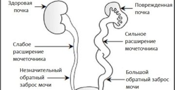 Рефлюкс мочи в почки