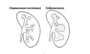 Гидрокаликоз почки у беременных