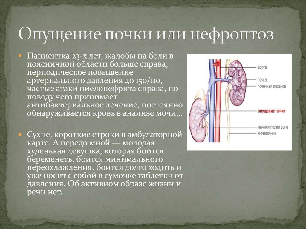 Опущение почки на 9 см лечение