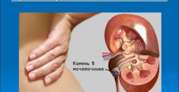 Почечная колика справа