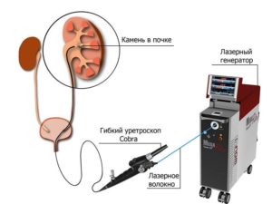 Лечение лазером почки