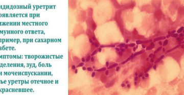 Грибковый уретрит у женщин симптомы
