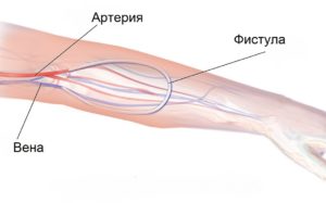 Что такое фистула в медицине