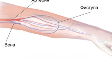 Что такое фистула в медицине