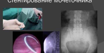 Болит почка после установки стента