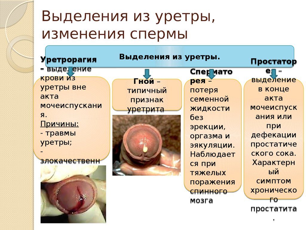 Белые выделения при мочеиспускании