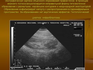 В верхнем полюсе левой почки объемное образование