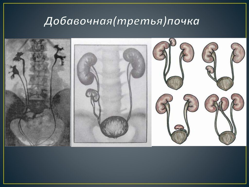 Три почки у человека что это значит