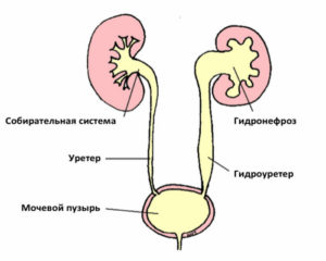 Мочеточник не лоцируется что это