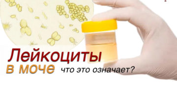 Лейкоциты в моче 200 что это значит