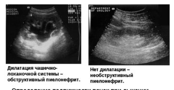 Узи почек члк
