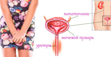 Как лечить цистит уретрит у женщин