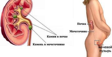Как лечат камни в почках у беременных