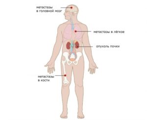 Метастазы почек рак