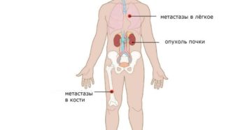 Метастазы почек рак