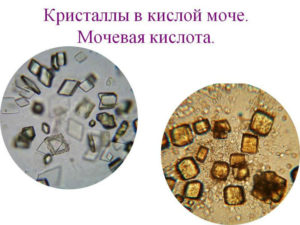 Мочевая кислота в моче у ребенка