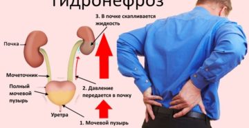 Признаки заболевания правой почки