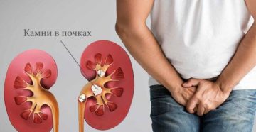 Камень в почке у мужчины что делать