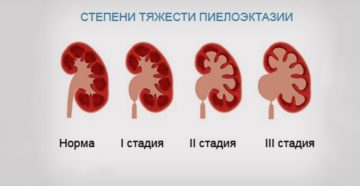 Пиелоэктазия правой почки у взрослого