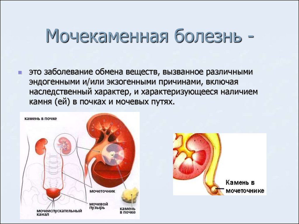 Мочекаменная болезнь у мужчин обострение