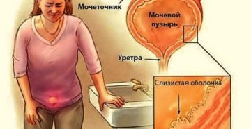 Болит мочевой пузырь по утрам у женщин